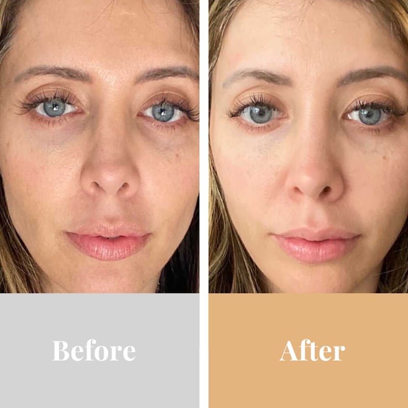 Omnilux contour before and after