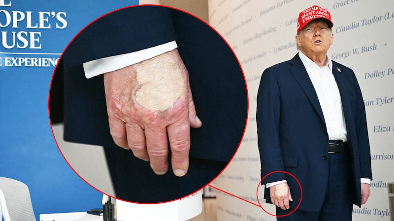 Make-up concealer on President Donald Trump's hand is seen as he speaks at "The People's House."