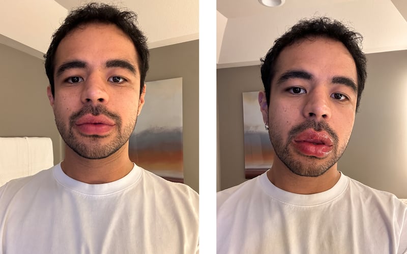 Ourself Lip Filler Before and After